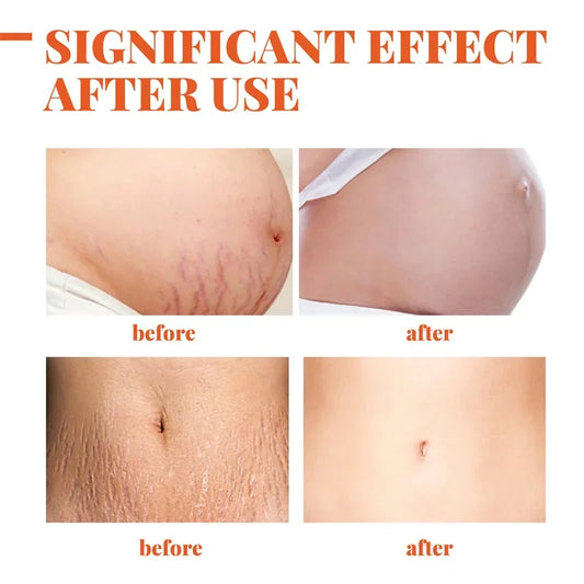 Removes Stretch Mark Cream Postpartum Repair Fade Stretch Marks Prevent Obesity Lifting Firming Moisturizing Brighten Skin Care