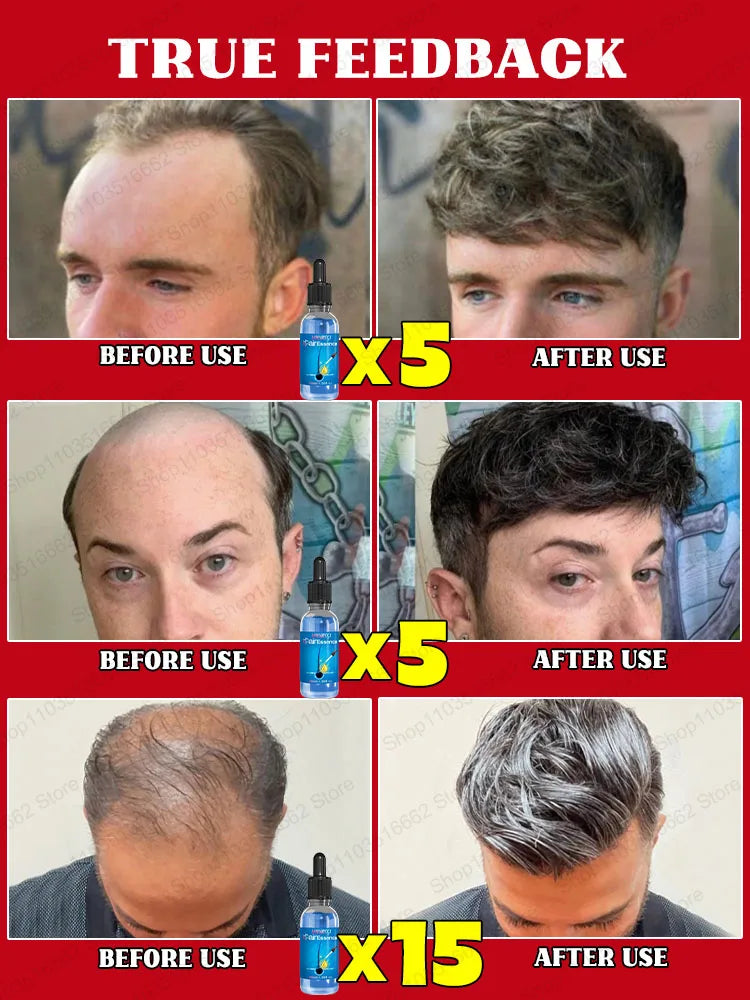 WPRBREGT Hair Growth Essential Oil – 30ml Blue Bottle Serum for Baldness Repair & Follicle Activation