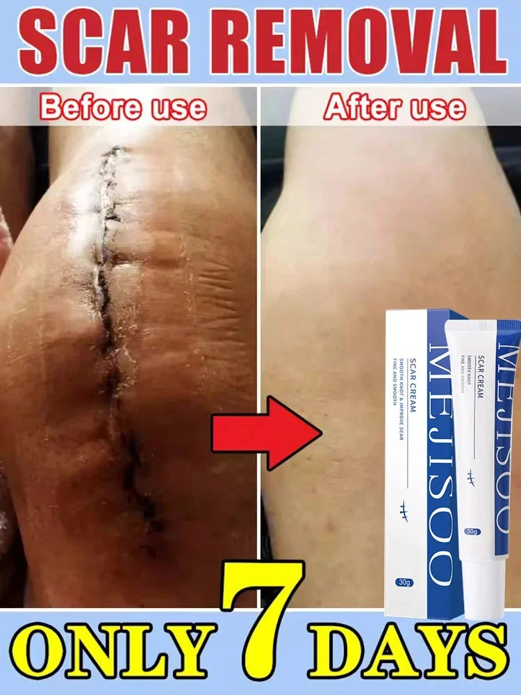 Scar Removal Cream Gel Remove Acne Spots Treatment Stretch Marks Burn Surgical Scar Repair Cream Smoothing Whitening Skin Beauty
