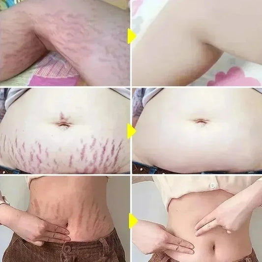 Cream For Pregnancy Stretch Marks Removal Eliminate Red White Old Stretch Marks 2025