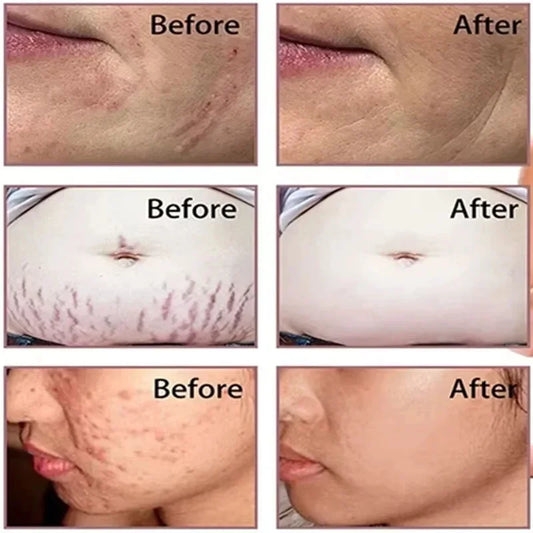 Scar Removal Cream Gel Remove Acne Spots Treatment Stretch Marks Burn Surgical Scar Repair Cream Smoothing Whitening Skin Beauty