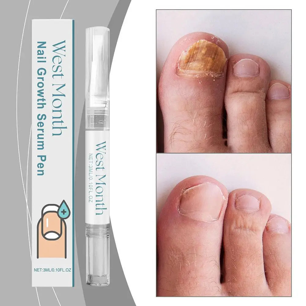 Nail Growth Serum Pen Cuticle Nutrition Solution Preventing And Nail Peeling Cracked Brittled Nail Care Dryness
