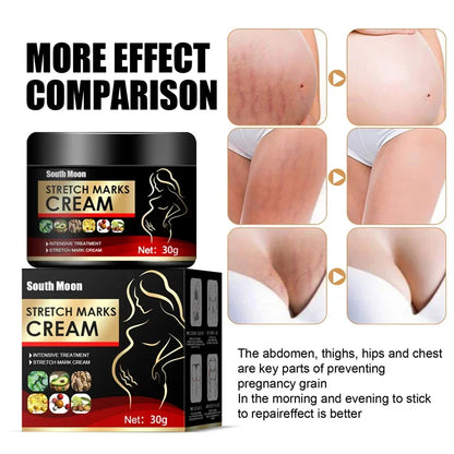 Effective Remove Pregnancy Scars Acne Cream Stretch Mark Treatment Maternity Repair Anti-Aging Anti-Winkle Firming Body Cream
