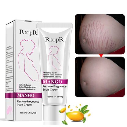 RtopR Remove Pregnancy Scars Acne Cream Stretch Marks Treatment Maternity Repair Anti-Aging Anti Winkles Firming Body Creams