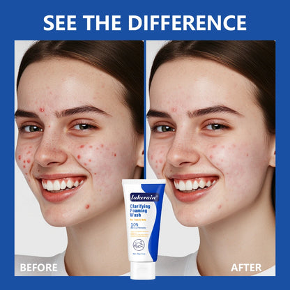 Lakerain | Benzoyl Peroxide 10% | Acne Treatment & Deep Cleansing