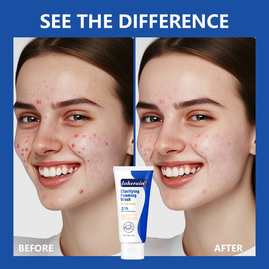 Lakerain | Benzoyl Peroxide 10% | Acne Treatment & Deep Cleansing