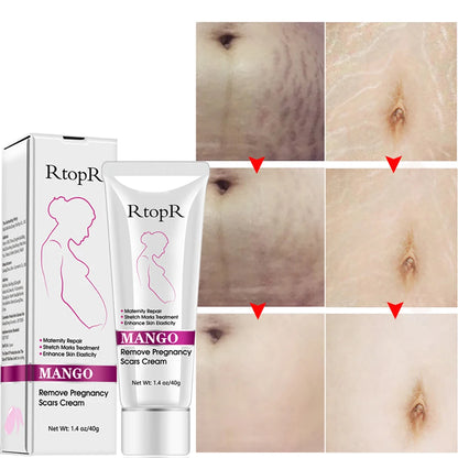 RtopR Remove Pregnancy Scars Acne Cream Stretch Marks Treatment Maternity Repair Anti-Aging Anti Winkles Firming Body Creams