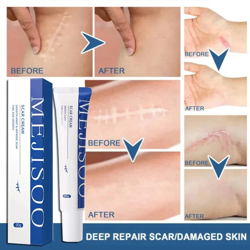 Scar Removal Cream Gel Remove Acne Spots Treatment Stretch Marks Burn Surgical Scar Repair Cream Smoothing Whitening Skin Beauty