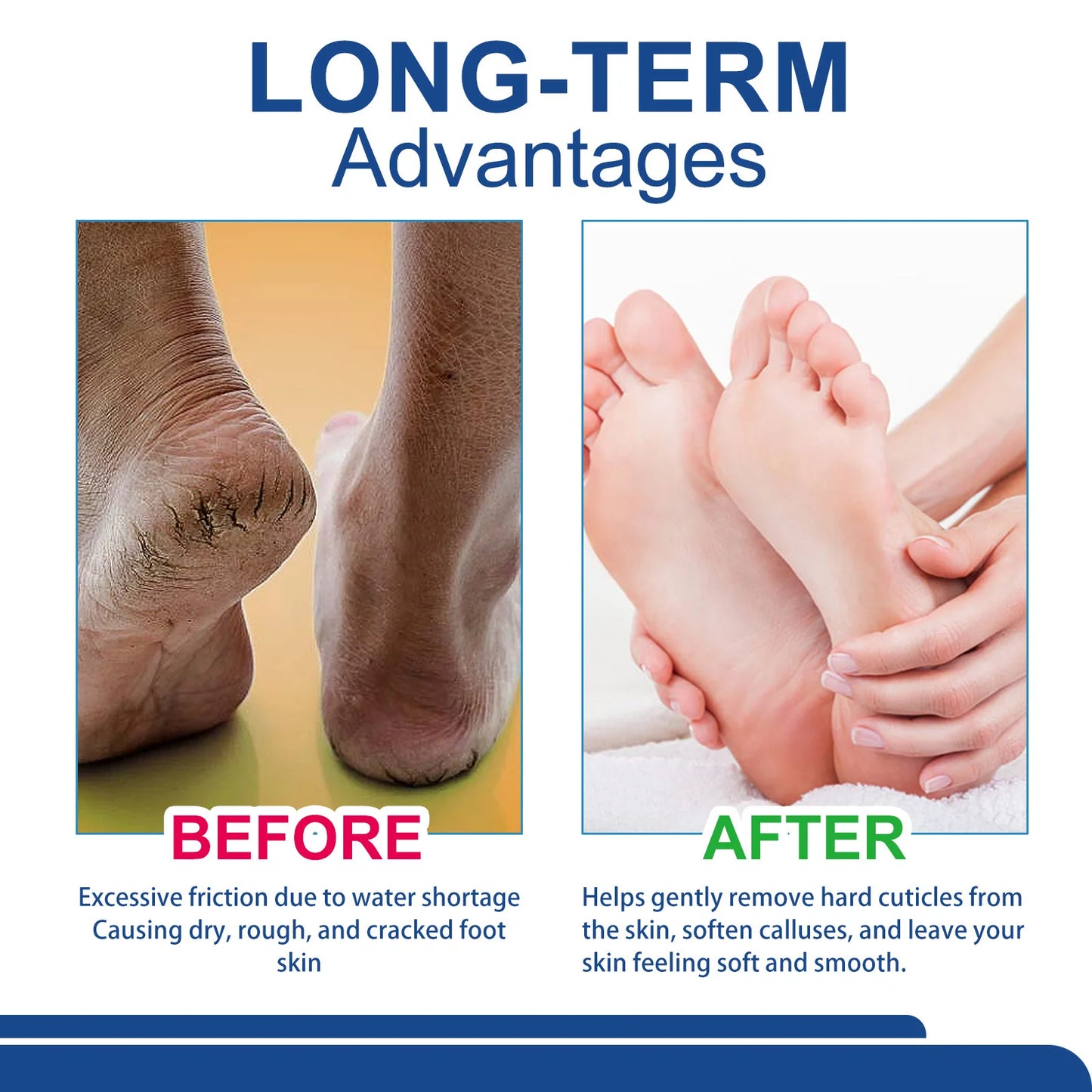 60% Urea Foot Cream Aloe Vera Ultra-hydrating Softening Dry Cracked Feet Cream Gentle Exfoliation Daily Foot Care Solution 40g
