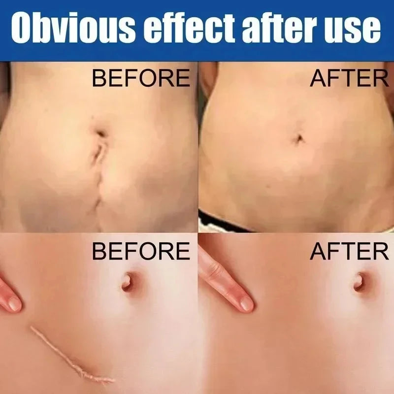 15g Scar Removing Cream Stretch Mark Removal Gel Face Body Acne Marks Injury Cesarean Burn Abrasions Scars Skin Repair Cream