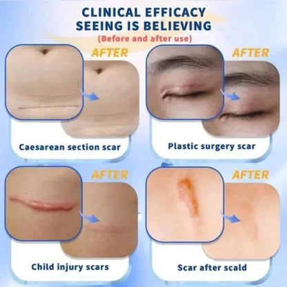 Scar Removal Cream Gel Remove Acne Spots Treatment Stretch Marks Burn Surgical Scar Repair Cream Smoothing Whitening Skin Beauty