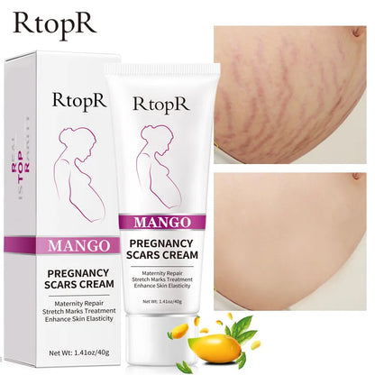 RtopR Remove Pregnancy Scars Acne Cream Stretch Marks Treatment Maternity Repair Anti-Aging Anti Winkles Firming Body Creams
