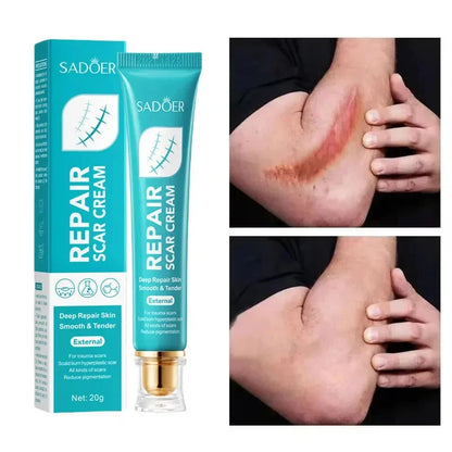 Scar Removal Cream Gel Remove Acne Spots Treatment Stretch Marks Burn Surgical Scar Repair Cream Smoothing Whitening Skin Beauty