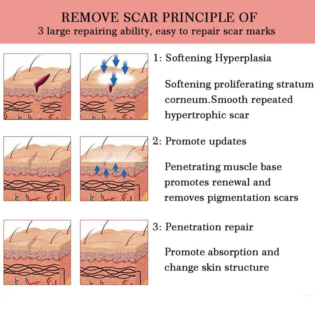 5X Yoxier Lavender Scar Repair Cream Acne Scar Removal Remove Pigmentation Scar Marks Stretch Smooth Skin Care Whitening Cream