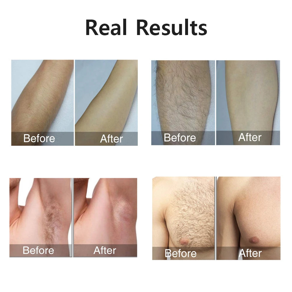 Portable IPL Laser Epilator | 999,999 Flashes | Painless Permanent Hair Removal for Women’s Body & Bikini Line