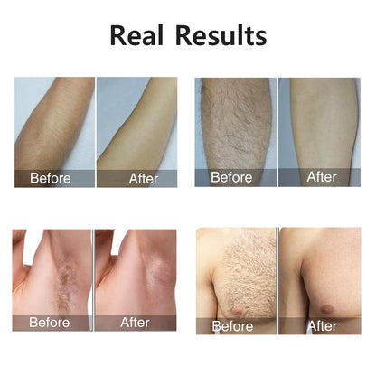 Portable IPL Laser Epilator | 999,999 Flashes | Painless Permanent Hair Removal for Women’s Body & Bikini Line