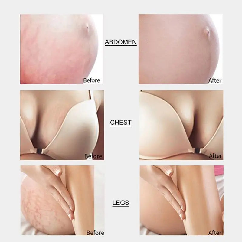 Stretch Marks Remover Cream Eliminate Pregnancy Scars Maternity Repair Anti Winkle Skin Firming