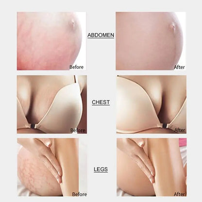 Stretch Marks Remover Cream Eliminate Pregnancy Scars Maternity Repair Anti Winkle Skin Firming