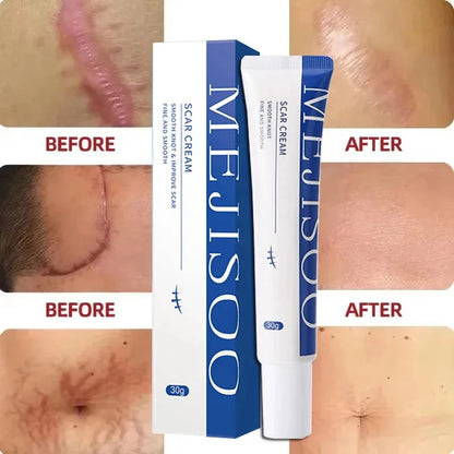 Scar Removal Cream Gel Remove Acne Spots Treatment Stretch Marks Burn Surgical Scar Repair Cream Smoothing Whitening Skin Beauty