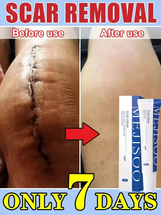 Scar Removal Cream Gel Remove Acne Spots Treatment Stretch Marks Burn Surgical Scar Repair Cream Smoothing Whitening Skin Beauty