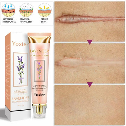 5X Yoxier Lavender Scar Repair Cream Acne Scar Removal Remove Pigmentation Scar Marks Stretch Smooth Skin Care Whitening Cream