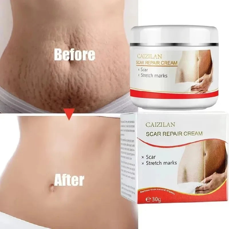 Stretch Marks Permanent Removal Cream Eliminate Body Belly Stretch Marks Swelling Marks Remove Skin Cracks Repair Firming Care