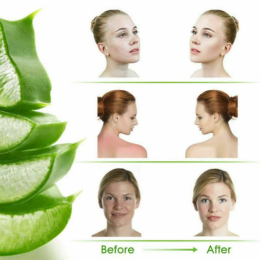 Natural Aloe Vera Gel | 100% Pure Moisturizer | Soothing, Freckles & Melasma Care, Face Primer – 40g