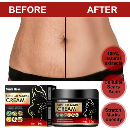 Effective Remove Pregnancy Scars Acne Cream Stretch Mark Treatment Maternity Repair Anti-Aging Anti-Winkle Firming Body Cream
