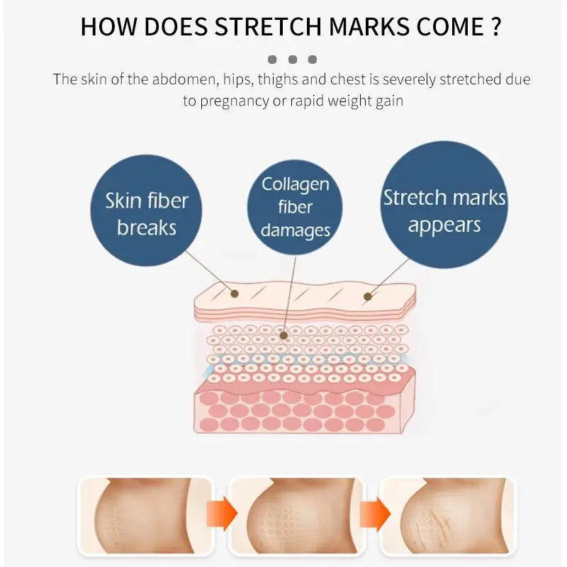 Stretch Marks Remover Cream Eliminate Pregnancy Scars Maternity Repair Anti Winkle Skin Firming