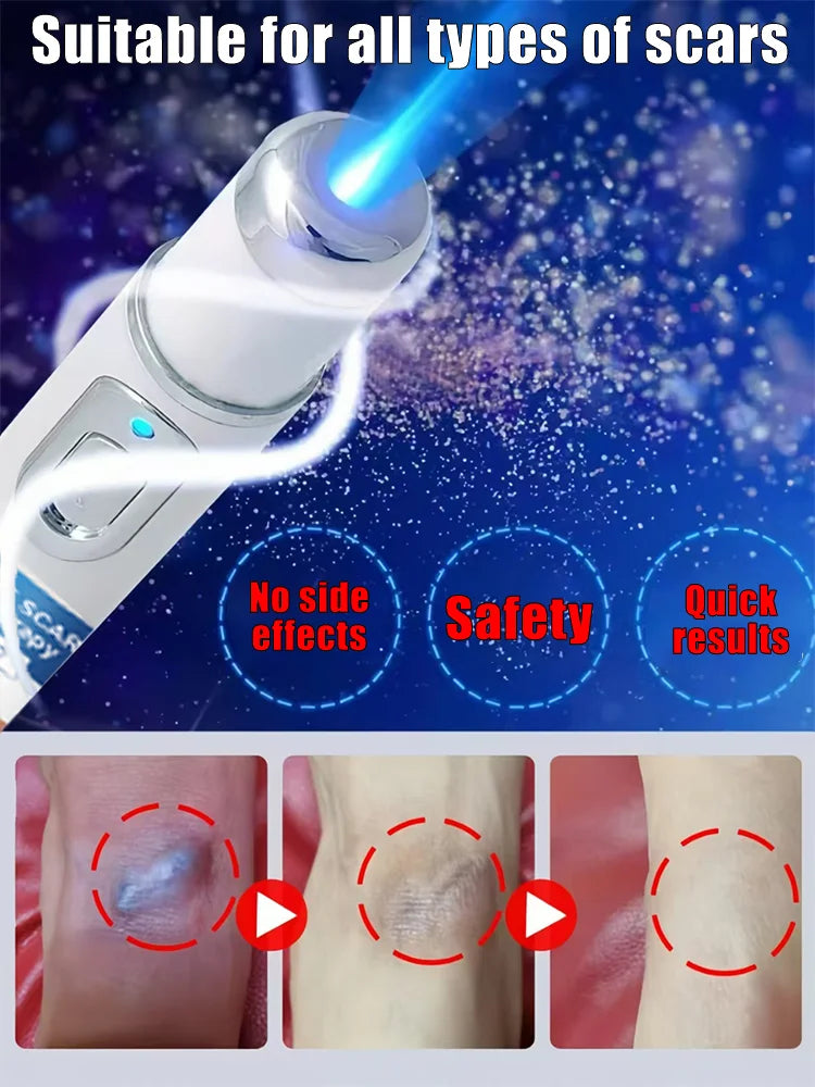 Magic scar removal tool, removes scars, burns, stretch marks, acne marks and other scars