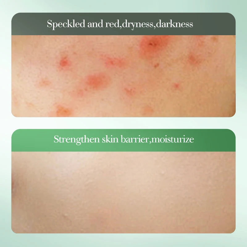 SADOER | 3% Salicylic Acid Acne Repair Toner | Acne Control, Pore Minimizing & Skin Soothing