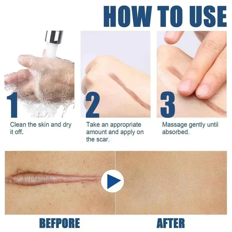 15g Scar Removing Cream Stretch Mark Removal Gel Face Body Acne Marks Injury Cesarean Burn Abrasions Scars Skin Repair Cream