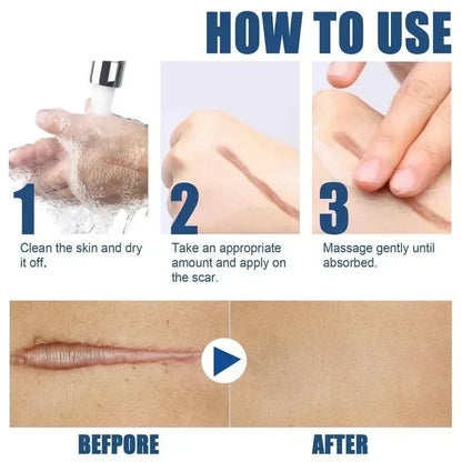15g Scar Removing Cream Stretch Mark Removal Gel Face Body Acne Marks Injury Cesarean Burn Abrasions Scars Skin Repair Cream